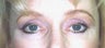 35 year old Female underwent brow lift to acquire more youthful look