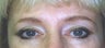 35 year old Female underwent brow lift to acquire more youthful look