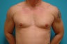 35 year old man with bilateral gynecomastia