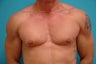 35 year old man with bilateral gynecomastia