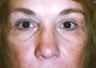 Blepharoplasty