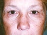 Blepharoplasty