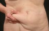 CoolSculpting