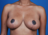 Breast Reduction