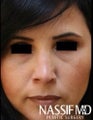 HIspanic Female Revision Rhinoplasty 