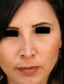 HIspanic Female Revision Rhinoplasty 