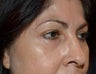Eyelid Surgery