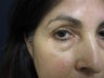 Eyelid Surgery