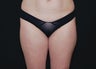 Liposuction