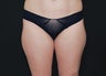 Liposuction