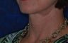 Facelift