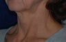 Facelift