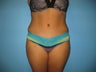 Tummy Tuck