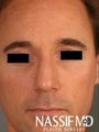 Male Primary Rhinoplasty 