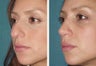 Rhinoplasty