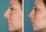 Rhinoplasty