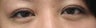 Bilateral Asian Eyelid Surgery