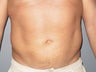 Liposuction