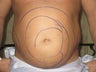 Liposuction