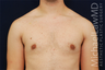 Male Breast Reduction