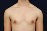 Male Breast Reduction