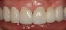 Replacing Old Crowns with Ceramic Crowns