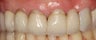 Replacing Old Crowns with Ceramic Crowns