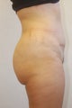 Buttock Enhancement
