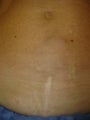 Bulging abdominal wall veins in 42 year old female