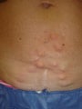 Bulging abdominal wall veins in 42 year old female
