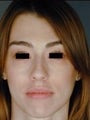 Primary Female Rhinoplasty 