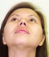Asian Rhinoplasty 