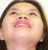 Asian Rhinoplasty 