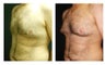 Male Breast Reduction 