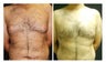 Male Breast Reduction 