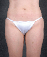 Liposuction 