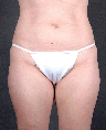 Liposuction 