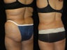 66 Year-Old Woman Treated for Bulky Fat of Bra Rolls, Flanks, and Waist