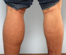 Calf Implants