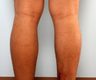 Calf Implants