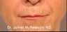Juvederm