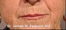 Juvederm