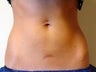 CoolSculpting