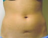 CoolSculpting