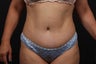 Tummy Tuck