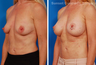 Breast Lift