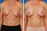 Breast Lift