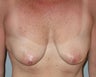 Breast Implants Improve Nipple Position 