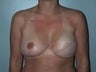 35 year old female patient who underwent breast reconstruction 