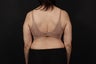 56 year old female, bra line back lift